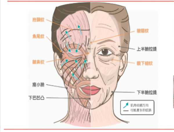 肉毒素是什么？在醫療美容行業的應用介紹